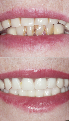 South Muskoka Dental Group dentures